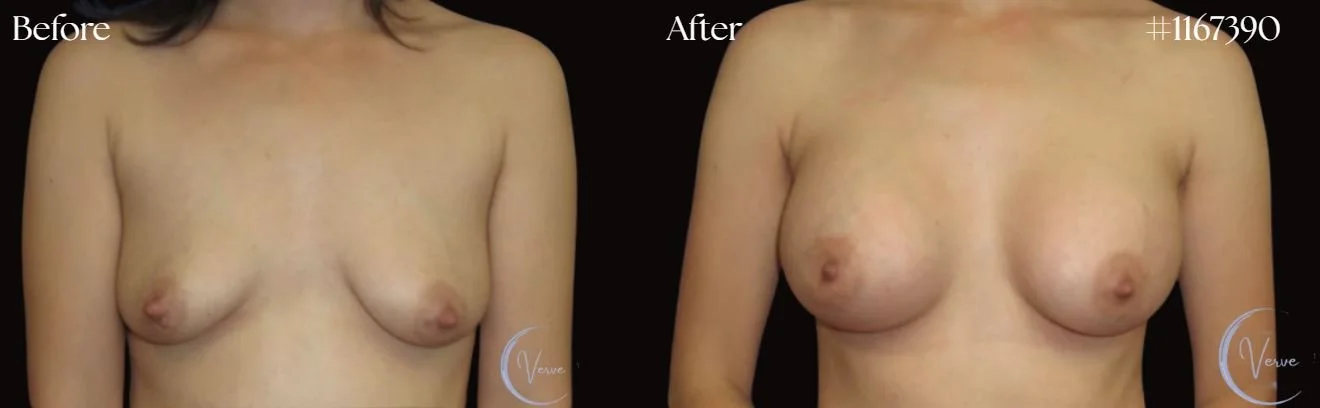 Breast Augmentation by Dr. Anshu Gupta — before and after