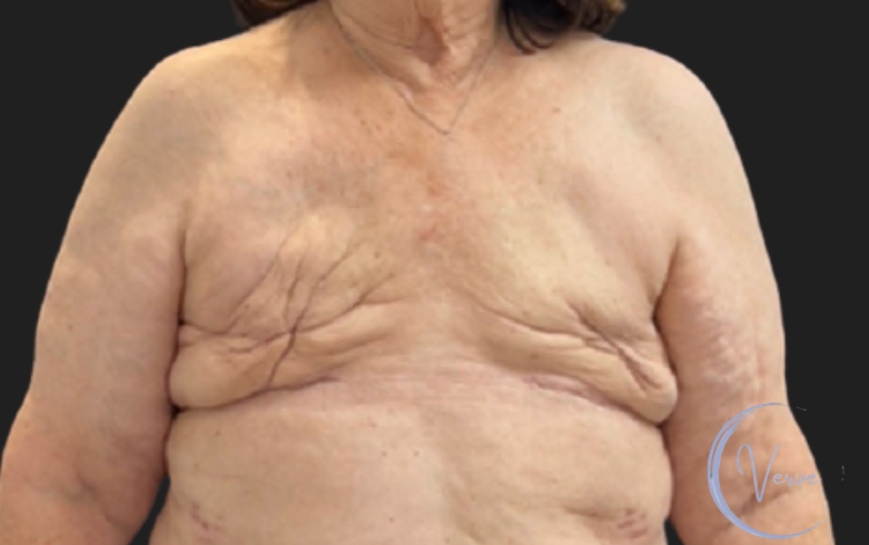 Breast Augmentation by Dr. Anshu Gupta — before and after