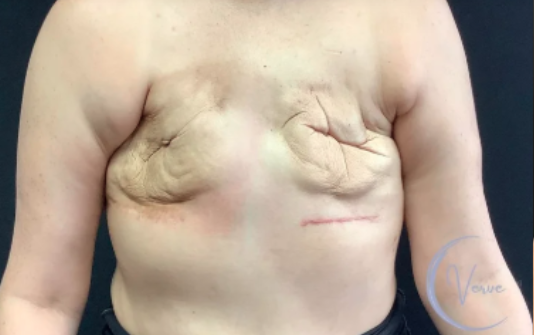 Breast Augmentation by Dr. Anshu Gupta — before and after