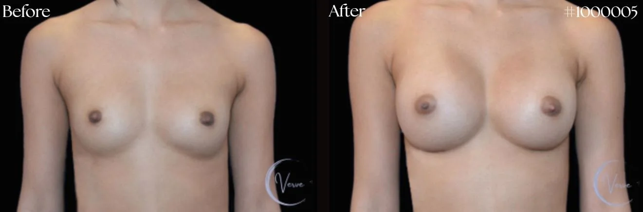 Breast Augmentation by Dr. Anshu Gupta — before and after