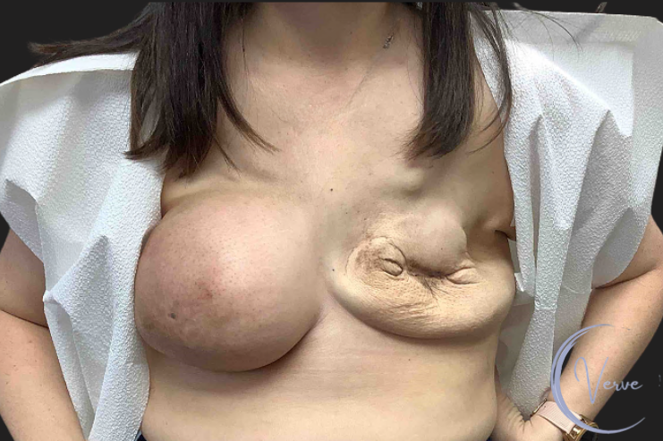 Breast Augmentation by Dr. Anshu Gupta — before and after