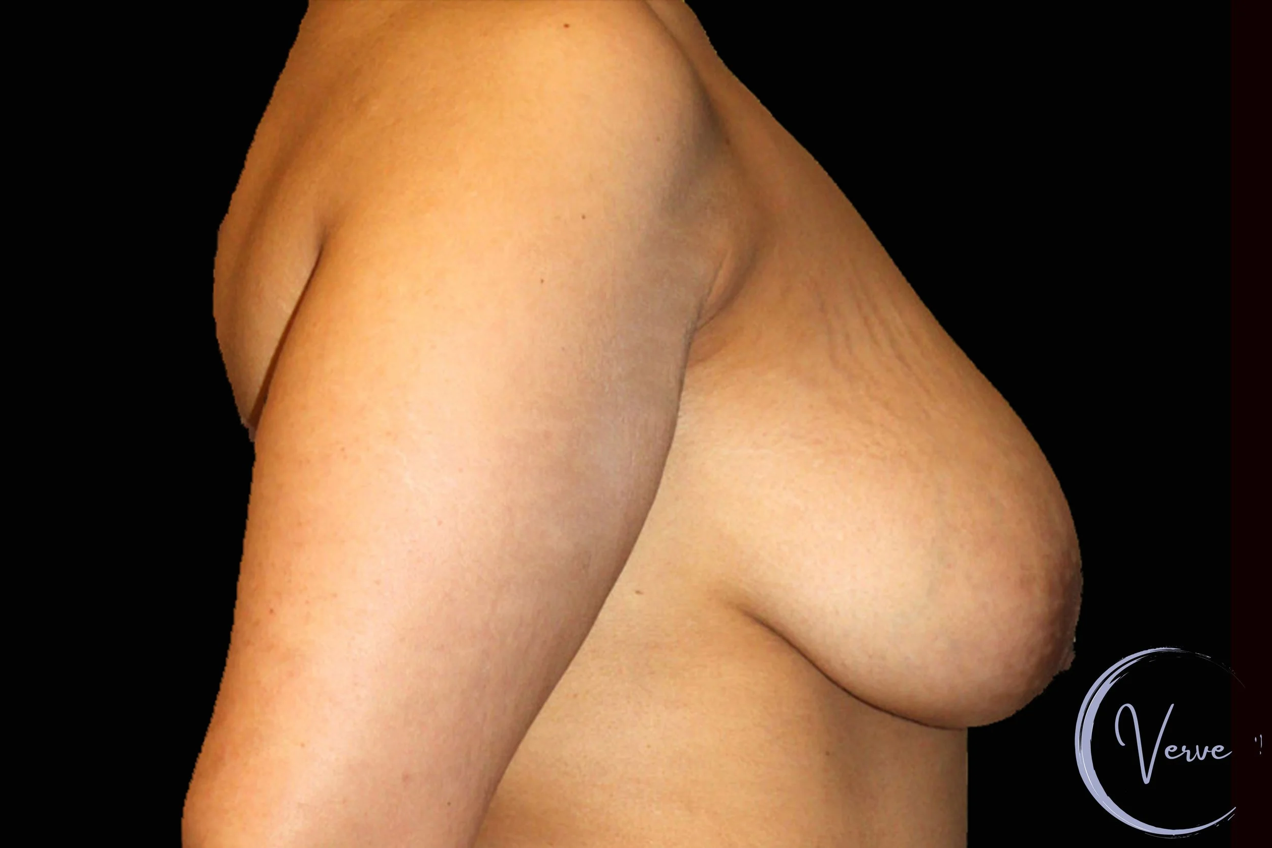 Breast Augmentation by Dr. Anshu Gupta — before and after