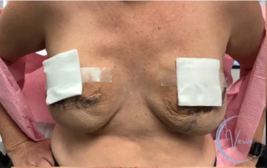 Breast Augmentation by Dr. Anshu Gupta — before and after