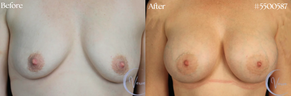 Breast Augmentation by Dr. Anshu Gupta — before and after