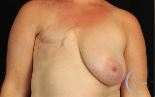 Breast Augmentation by Dr. Anshu Gupta — before and after