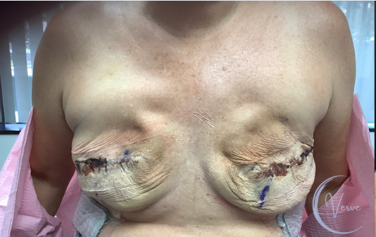 Breast Augmentation by Dr. Anshu Gupta — before and after