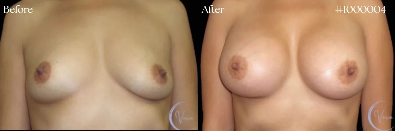 Breast Augmentation by Dr. Anshu Gupta — before and after
