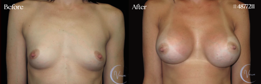 Breast Augmentation by Dr. Anshu Gupta — before and after