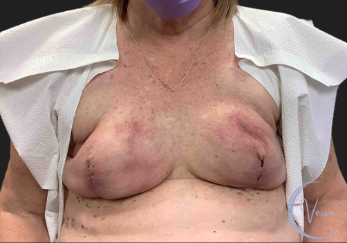 Breast Augmentation by Dr. Anshu Gupta — before and after