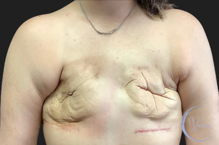 Breast Reconstruction by Dr. Anshu Gupta — before and after