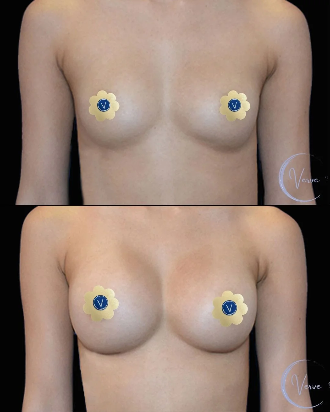 Breast Augmentation by Dr. Anshu Gupta — before