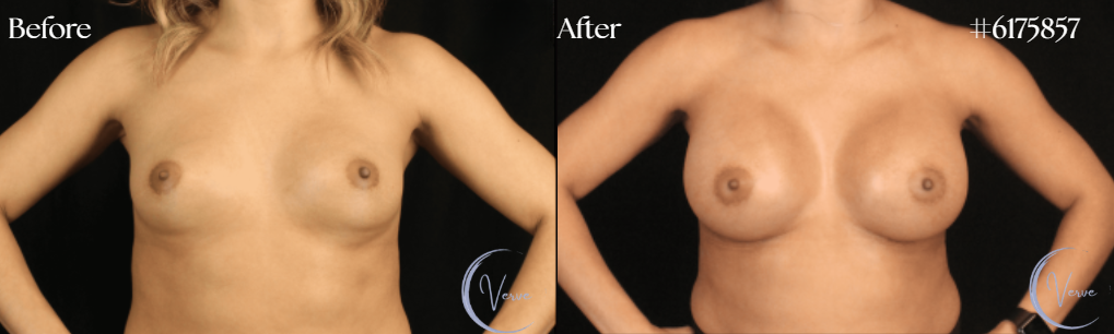 Breast Augmentation by Dr. Anshu Gupta — before and after