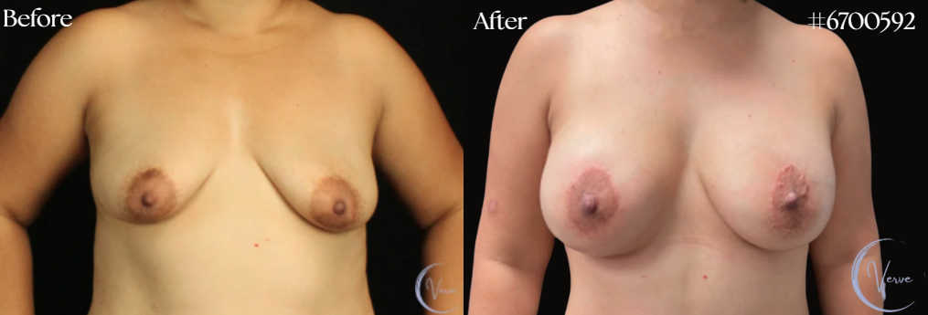 Breast Augmentation by Dr. Anshu Gupta — before and after