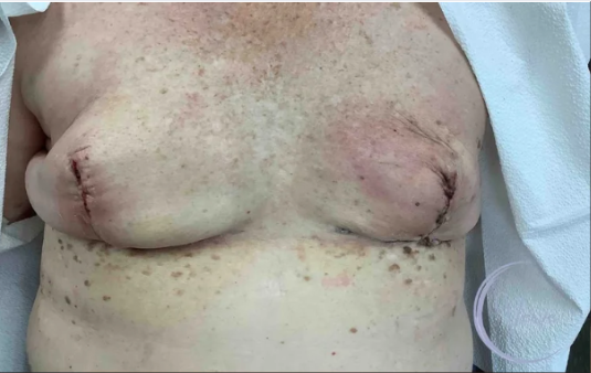 Breast Augmentation by Dr. Anshu Gupta — before and after