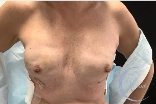 Breast Augmentation by Dr. Anshu Gupta — before and after