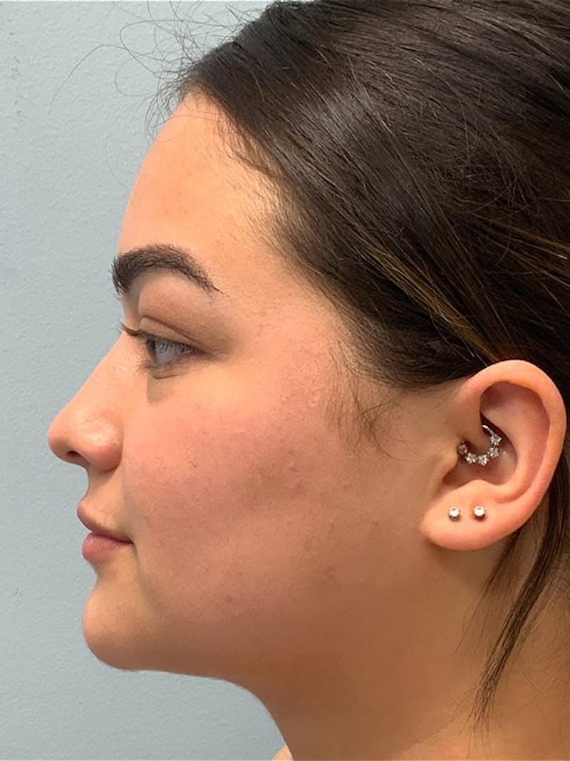Liposuction by Dr. Blake Sparks — after