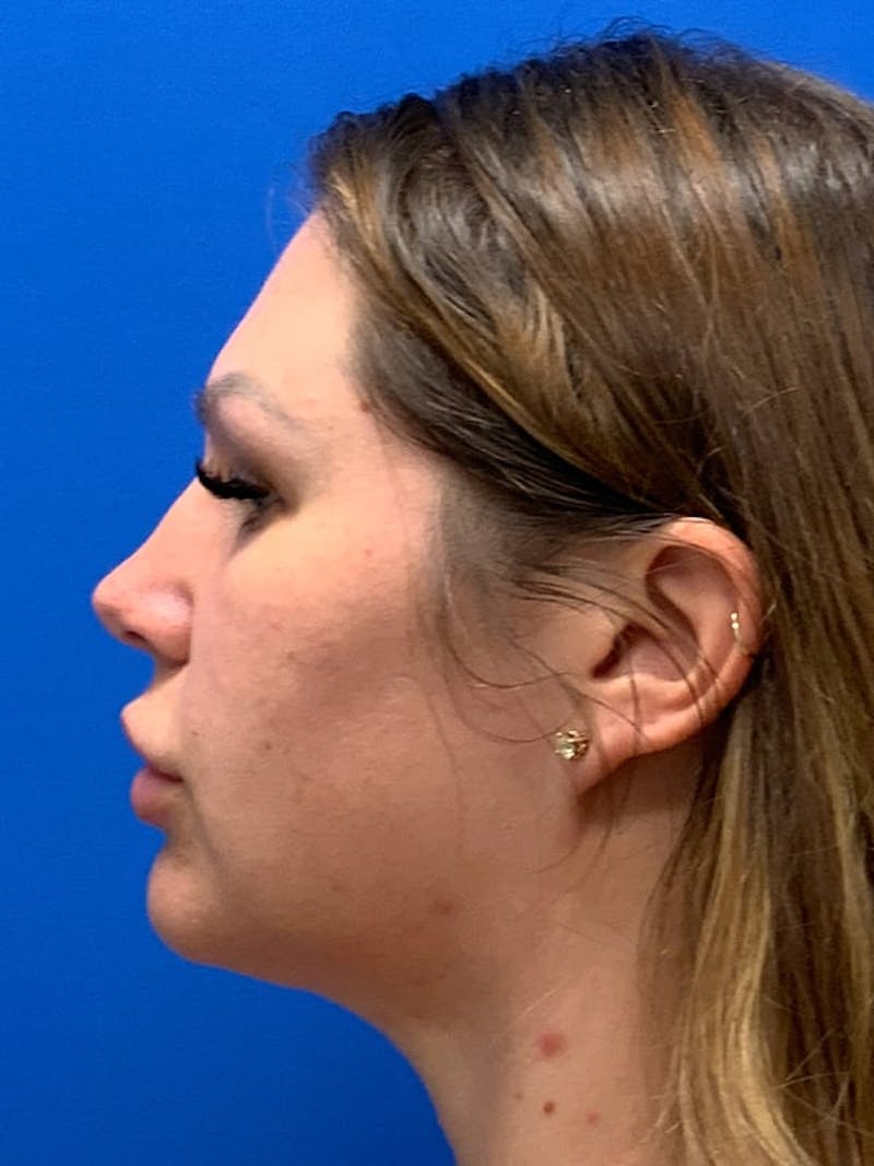 Liposuction by Dr. Blake Sparks — after