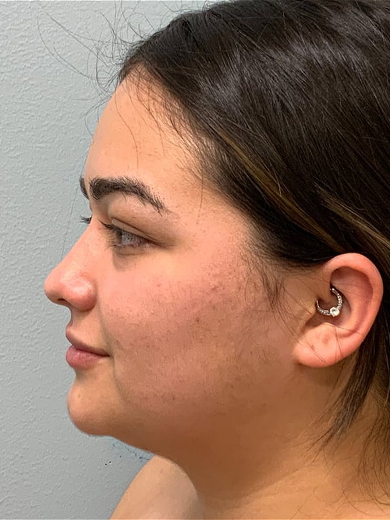 Liposuction by Dr. Blake Sparks — before