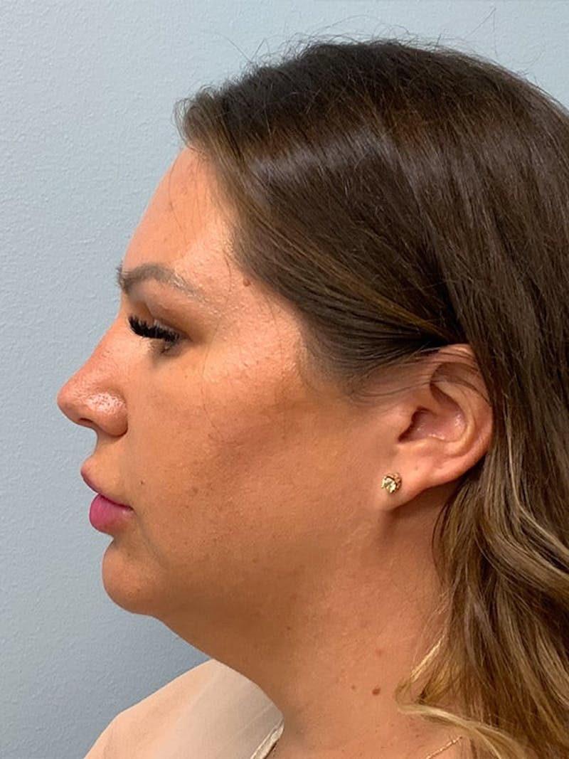 Liposuction by Dr. Blake Sparks — before