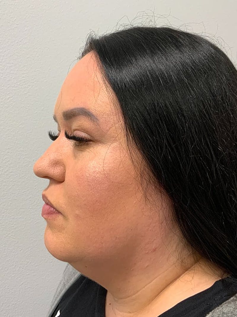 Liposuction by Dr. Blake Sparks — before
