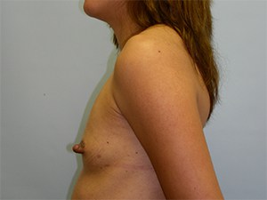 Breast Augmentation before and after - before