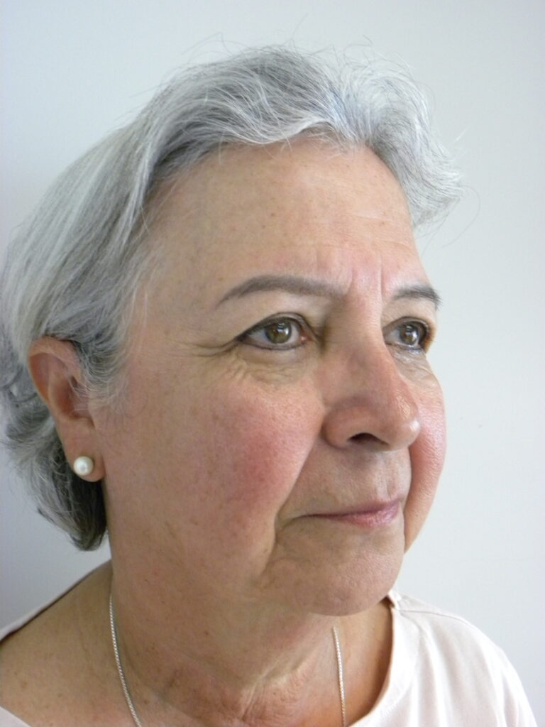 Blepharoplasty before and after - before
