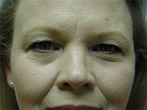 Blepharoplasty before and after - before