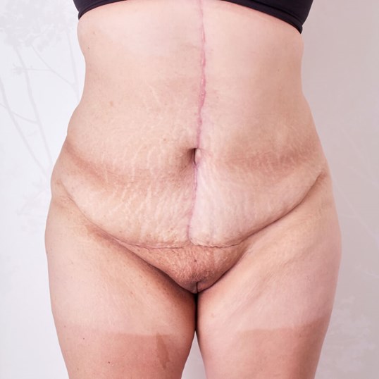 Tummy Tuck before and after - after