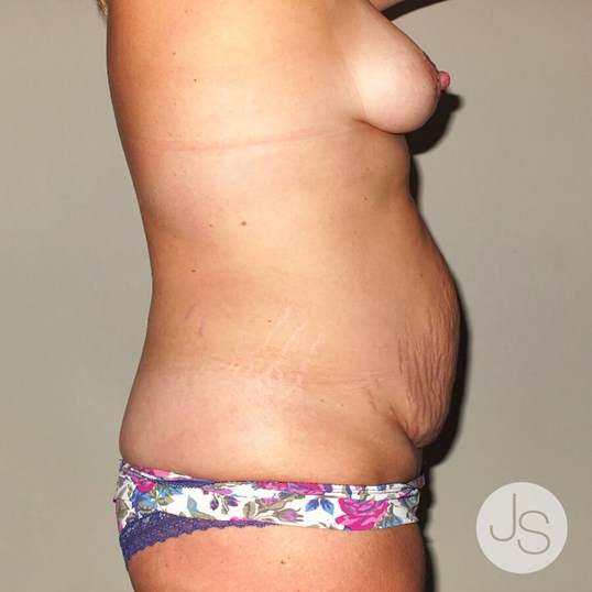 Tummy Tuck before and after - before