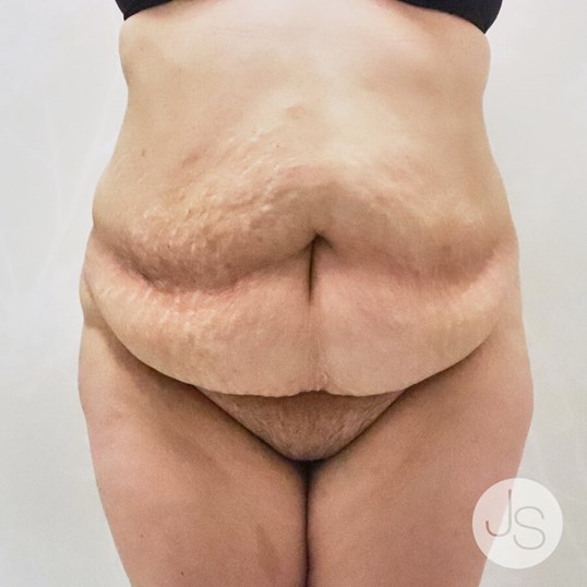 Tummy Tuck before and after - before