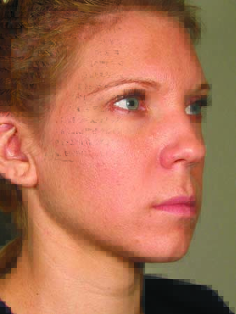Ultherapy before and after - after