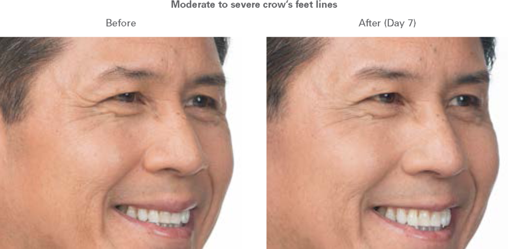 BOTOX Cosmetic before and after - after