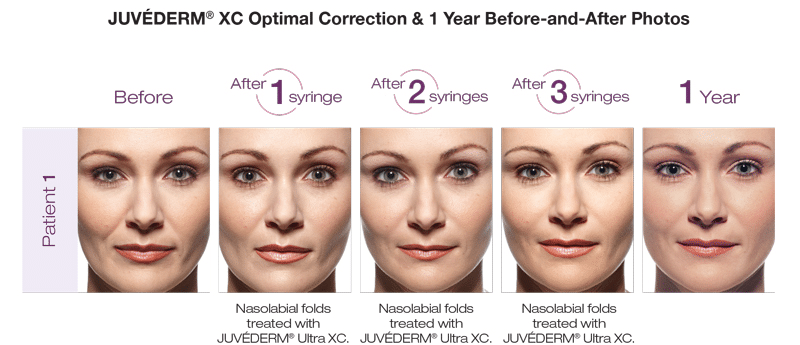 Juvederm before and after - after