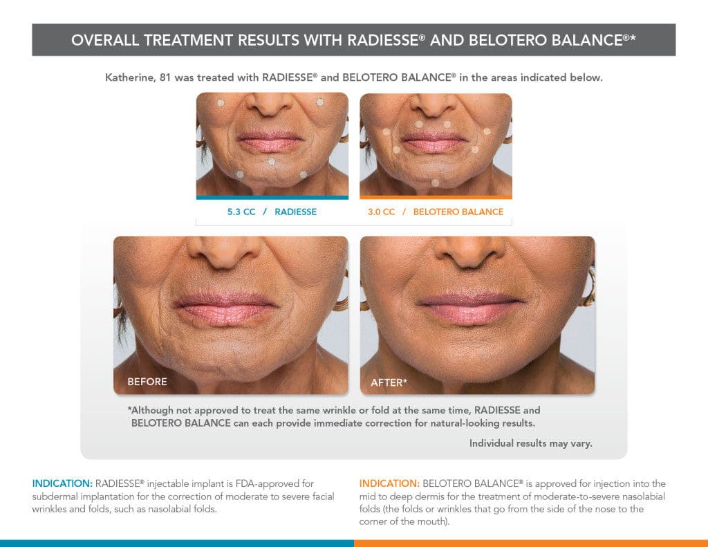 Radiesse & Belotero Balance before and after - after