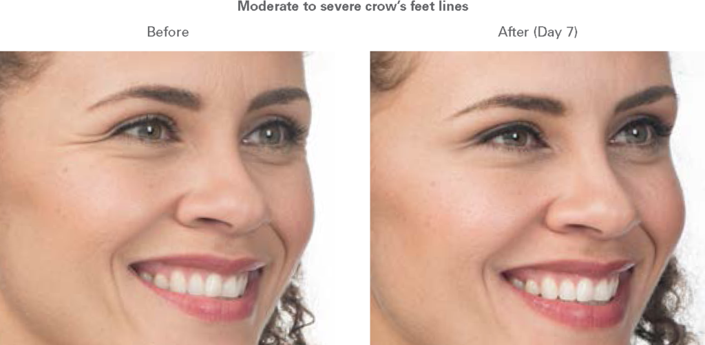 BOTOX Cosmetic before and after - before