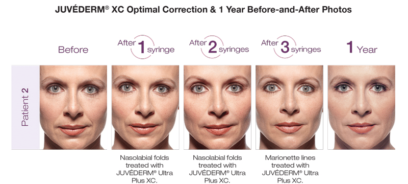 Juvederm before and after - before