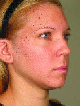 Ultherapy before and after - before