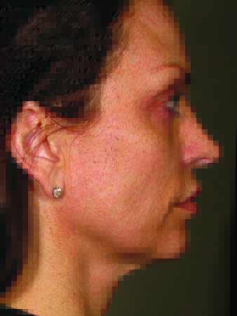 Ultherapy before and after - before