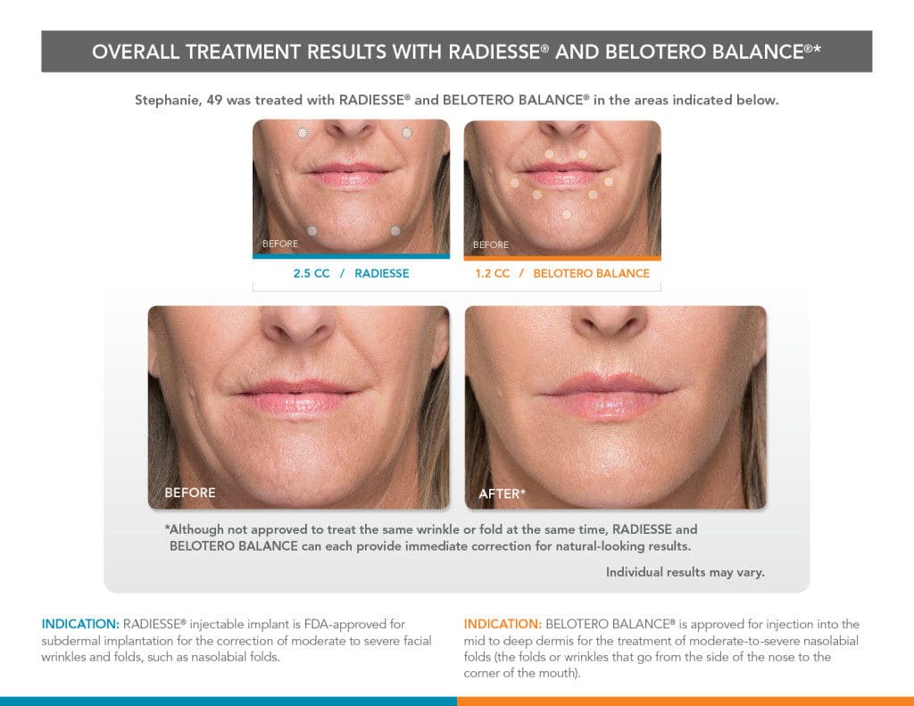 Radiesse & Belotero Balance before and after - before