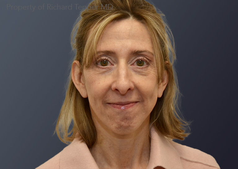 Facelift and Neck lift before and after - after