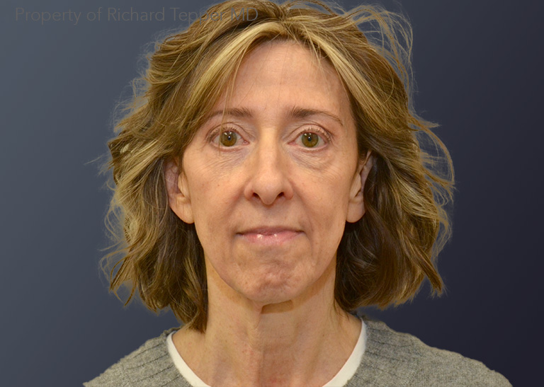 Facelift and Neck lift before and after - before