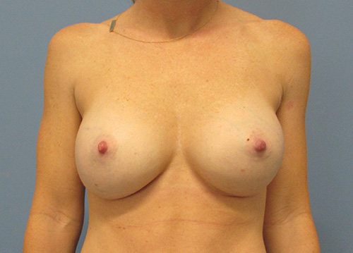 Breast Augmentation before and after - after