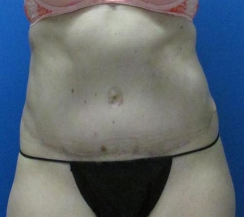 Tummy Tuck before and after - after
