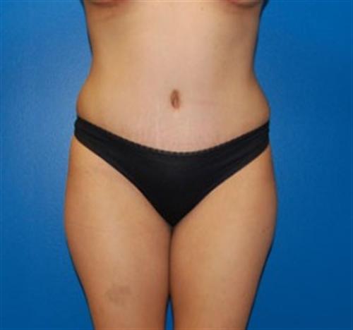 Mommy Makeover before and after - after