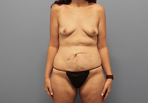 Liposuction before and after - before