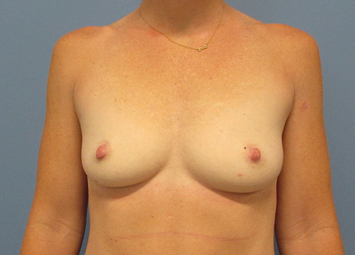 Breast Augmentation before and after - before