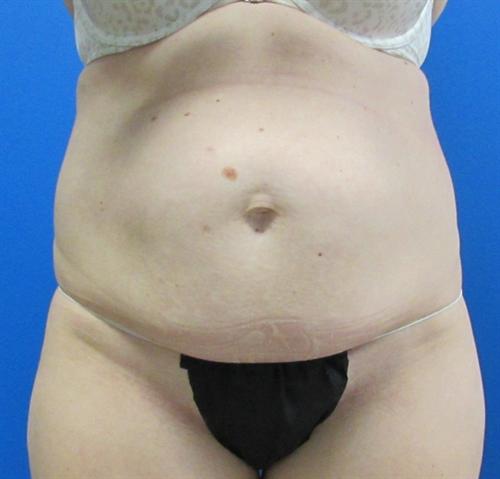Tummy Tuck before and after - before