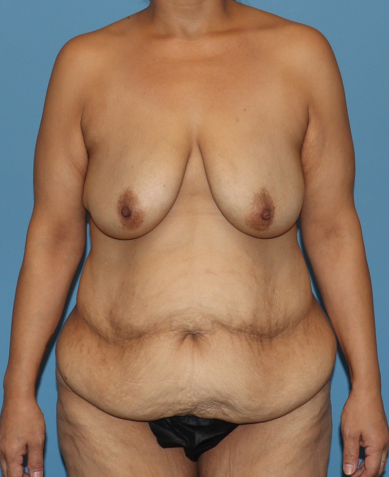 Tummy Tuck before and after - before