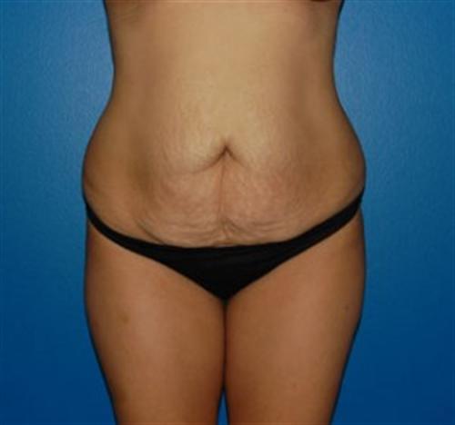 Mommy Makeover before and after - before