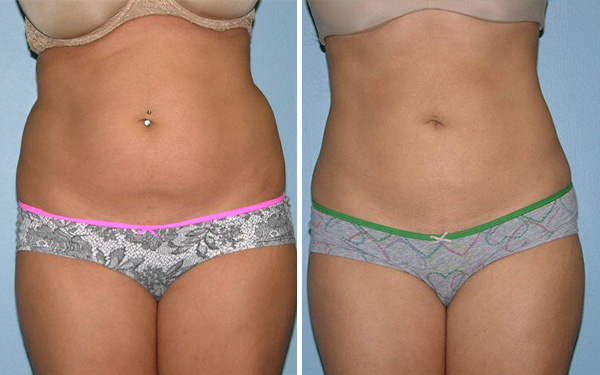 Liposuction before and after - after